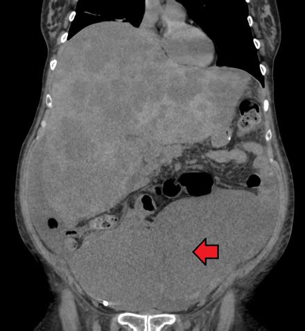 anal cancer wiki|Colorectal cancer .